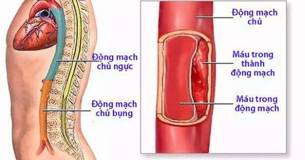 Phương pháp chẩn đoán nào được sử dụng để xác định nguyên nhân của sự đập trong bụng dưới?
