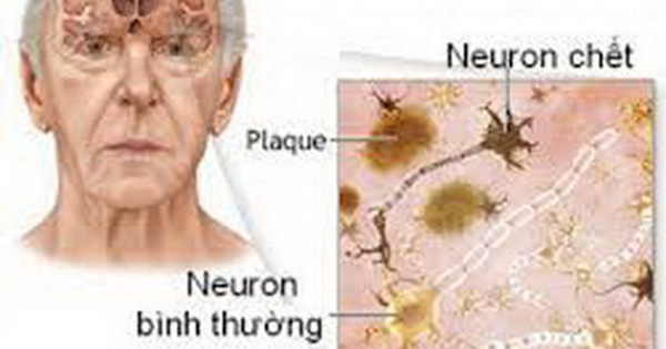 Triệu chứng chính của bệnh Alzheimer ở người cao tuổi là gì?

