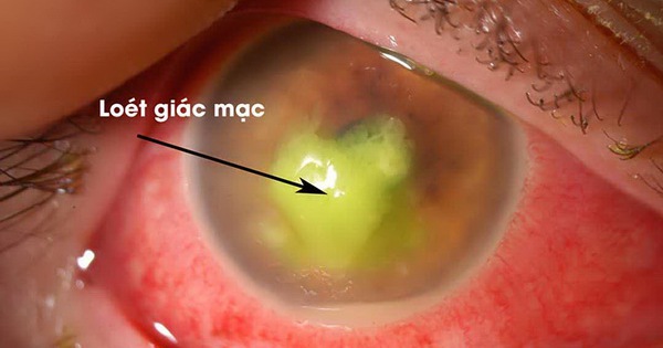 Viêm loét giác mạc nhiễm khuẩn: Nguy cơ cao gây mù lòa