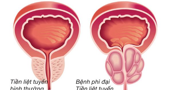 Triệu chứng của phì đại tuyến tiền liệt là gì?
