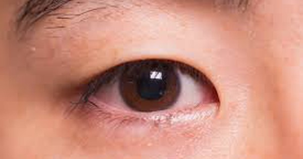 Thuốc Tobrex có an toàn không khi sử dụng để điều trị lẹo mắt?
