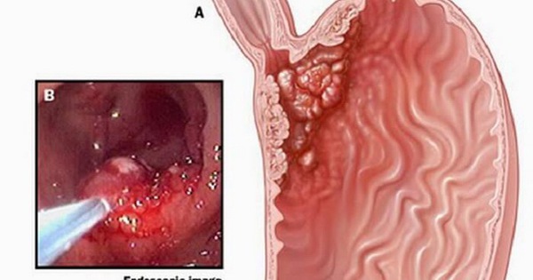 Dấu hiệu ung thư dạ dày giai đoạn sớm