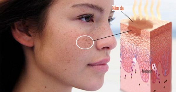 Cần làm gì khi bị rối loạn tăng sắc tố da mặt?