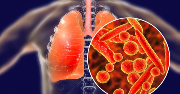 Các dấu hiệu và triệu chứng của bệnh lao phổi?
