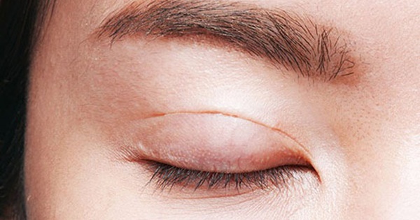 Massage mắt để từ 1 mí sáng 2 mí có hiệu quả ngay sau lần đầu thực hiện không?