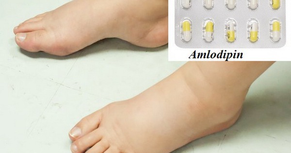 Tại sao thuốc huyết áp nhóm chẹn kênh Canxi như Amlodipine gây phù chân?
