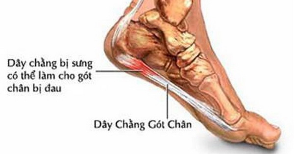 Nguyên nhân gây đau gót chân có phải bị gout và phương pháp điều trị