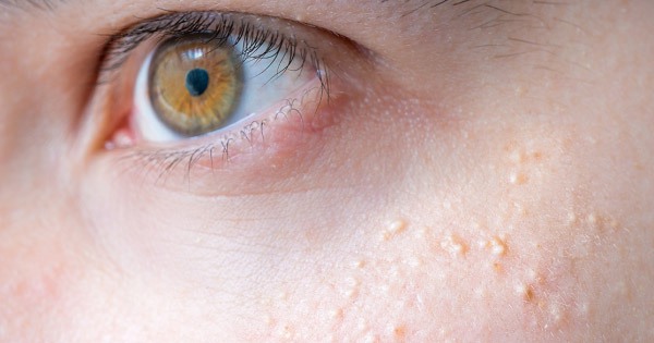 Có những biện pháp chăm sóc da hàng ngày để ngăn ngừa mụn cơm ở mắt không?
