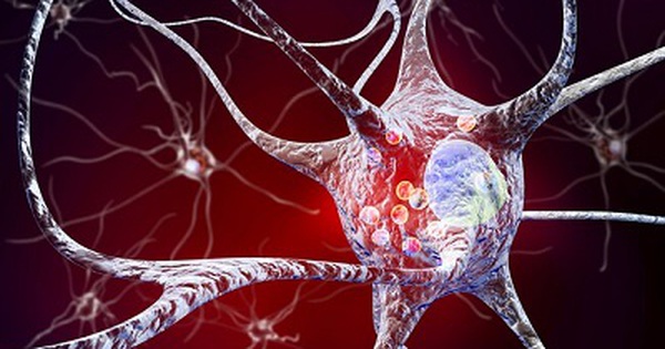Phương pháp mới điều trị bệnh Parkinson đang được nghiên cứu là gì?
