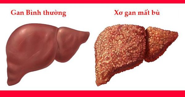 Bác sĩ khuyến nghị truyền albumin trong trường hợp nào?
