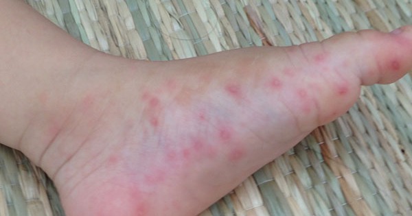 Những bệnh khác có triệu chứng giống mụn nước ở lòng bàn chân trẻ em là gì?
