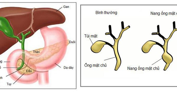 Cần phát hiện sớm u nang ống mật chủ