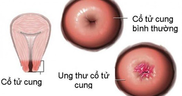 Ung thư cổ tử cung có thể điều trị thành công hay không?
