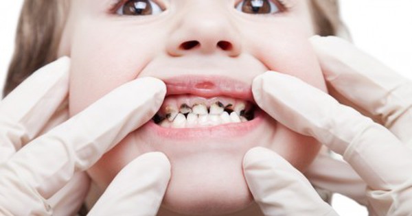 Những biện pháp chăm sóc răng sữa đúng cách để tránh trường hợp răng bị đen?
