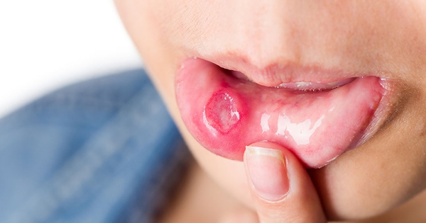 Điều trị ung thư khoang miệng có hiệu quả không? 

