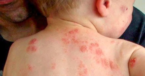 Các yếu tố dị nguyên như vật lý, sinh học và hóa học có thể gây ra bệnh eczema như thế nào?
