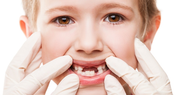 Người sún răng cần thực hiện những biện pháp chăm sóc răng miệng đặc biệt nào? 
