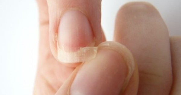 Móng tay giòn dễ gãy là tổn thương gì và cách điều trị?