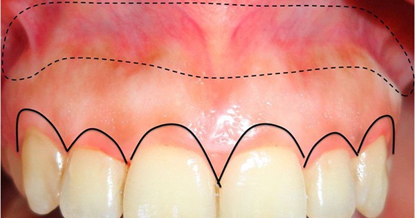 Các phương pháp điều trị viêm lợi sau khi bọc răng sứ là gì?
