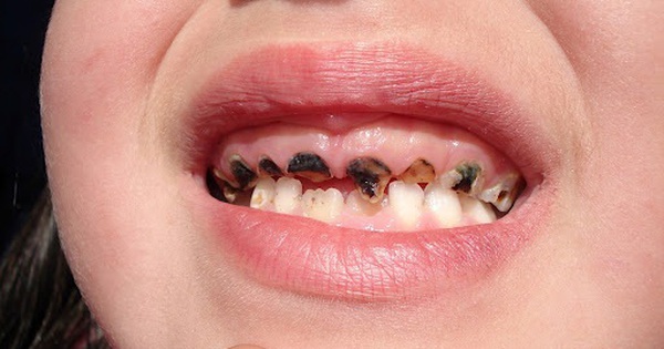 Sâu răng ở trẻ nhỏ