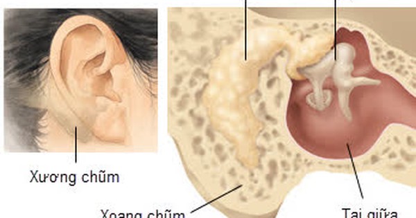 Viêm tai xương chũm cấp