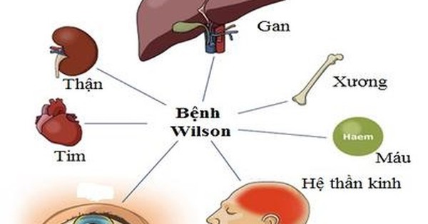 Thực phẩm chứa đồng nên tránh khi mắc bệnh Wilson? 
