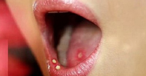 Có những thuốc và liệu pháp nào để điều trị nhiệt miệng trong cổ họng?
