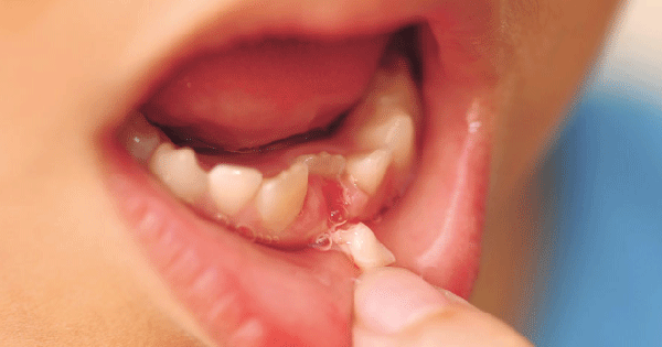 Răng sữa rụng có thể gây đau đớn cho trẻ không? 
