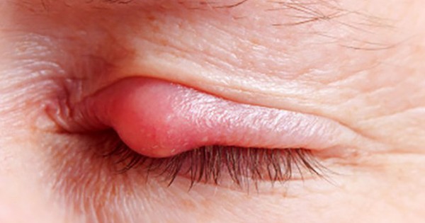 Điều gì gây ra tình trạng lẹo mắt khi mắt gặp phải nhiễm khuẩn?
