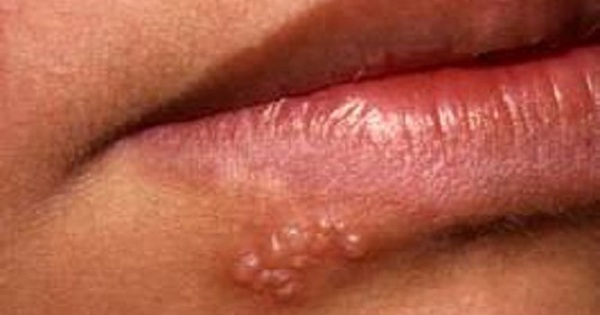 Có những yếu tố gây tăng nguy cơ nhiễm virus herpes là gì?
