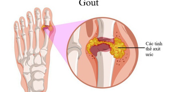 Các yếu tố nào có thể gây ra sự phát triển của bệnh gout?
