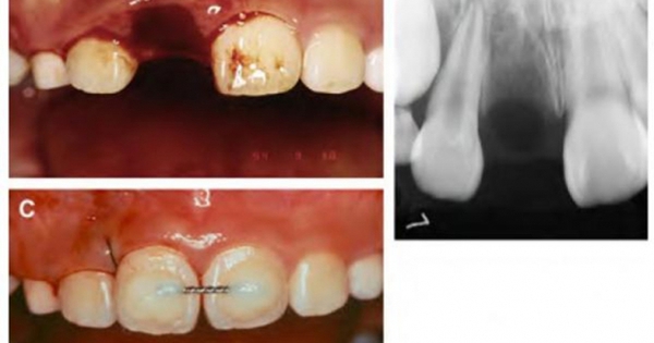 Răng bị gãy có thể được gắn lại được không?