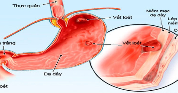 Dạ dày nhím có tính chất độc không?
