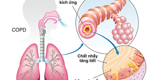Bệnh phổi tắc nghẽn mạn tính có thể điều trị hoàn toàn không?