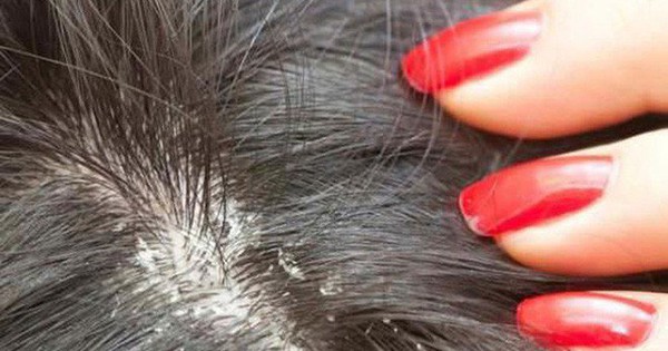 Có những biện pháp nào để ngăn ngừa tái phát nấm da đầu sau khi đã điều trị thành công?