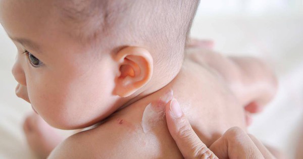 Eczema ở trẻ em là gì?
