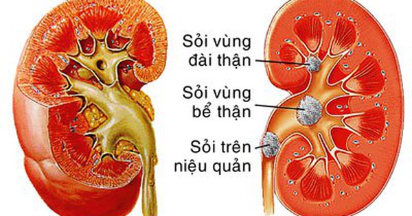 Kim tiền thảo râu ngô có tác dụng chữa sỏi bàng quang như thế nào?
