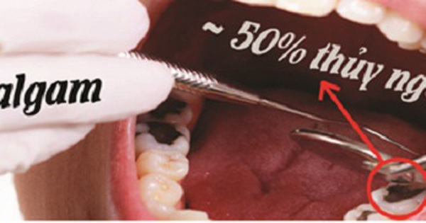 Chất hàn răng amalgam được sử dụng trong trám răng vì có thành phần chính là gì
