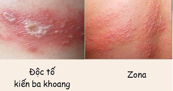 Nguyên nhân gây ra bệnh zona và viêm da do kiến ba khoang?
