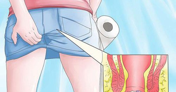 Dấu Hiệu Nào Để Biết Mình Đã Mắc Trĩ