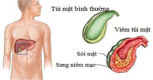 Có những yếu tố nào có thể tăng nguy cơ mắc sỏi mật và sỏi thận?
