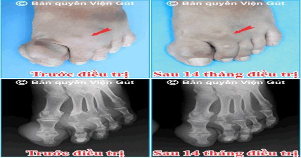 Có những yếu tố nào có thể gia tăng nguy cơ mắc gout nổi cục?
