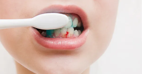 Tại sao cao răng cứng tích tụ quanh chân răng có thể gây chảy máu?
