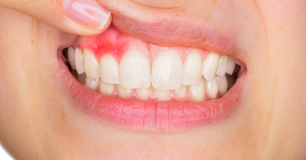 Có những biện pháp phòng tránh và kiểm soát vi khuẩn gây bệnh lợi chân răng?

