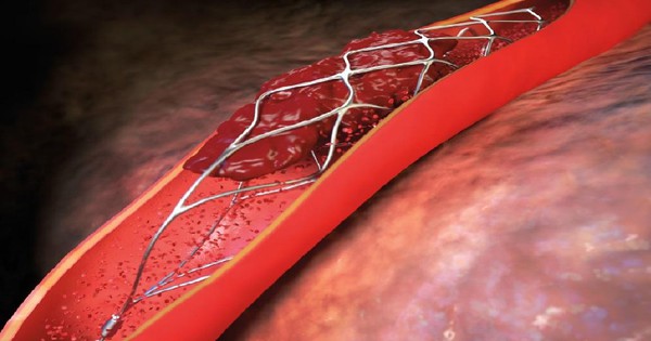 Chăm sóc sức khỏe bệnh mạch vành đã đặt stent hiệu quả và an toàn