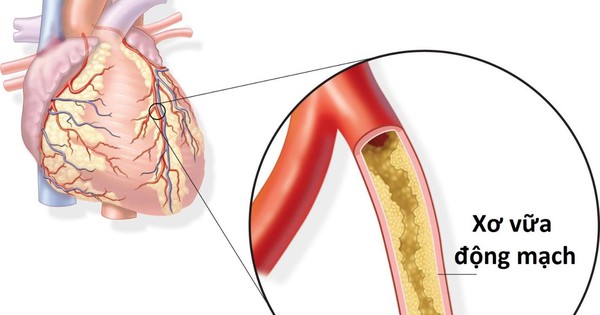 Thiếu máu cơ tim ảnh hưởng như thế nào đến tuổi thọ của người bệnh?

