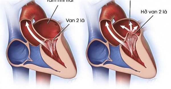 Tác dụng của cây Trúc đào trong việc điều trị bệnh hở van tim là gì?
