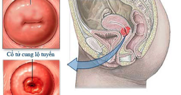 Phương pháp điều trị viêm lộ tuyến độ 1?
