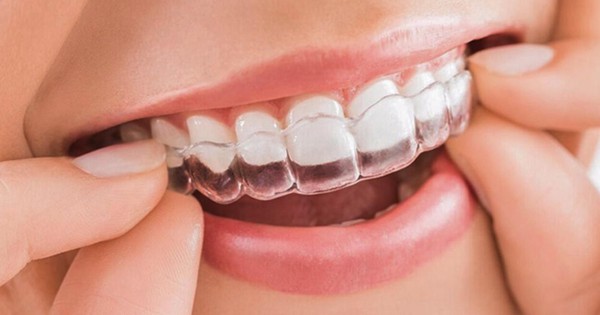 Có bao nhiêu loại niềng răng invisible trên thị trường hiện nay?
