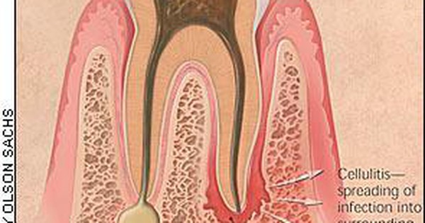 Viêm mô tế bào răng là gì? (Giải thích về khái niệm, nguyên nhân và triệu chứng của bệnh)
